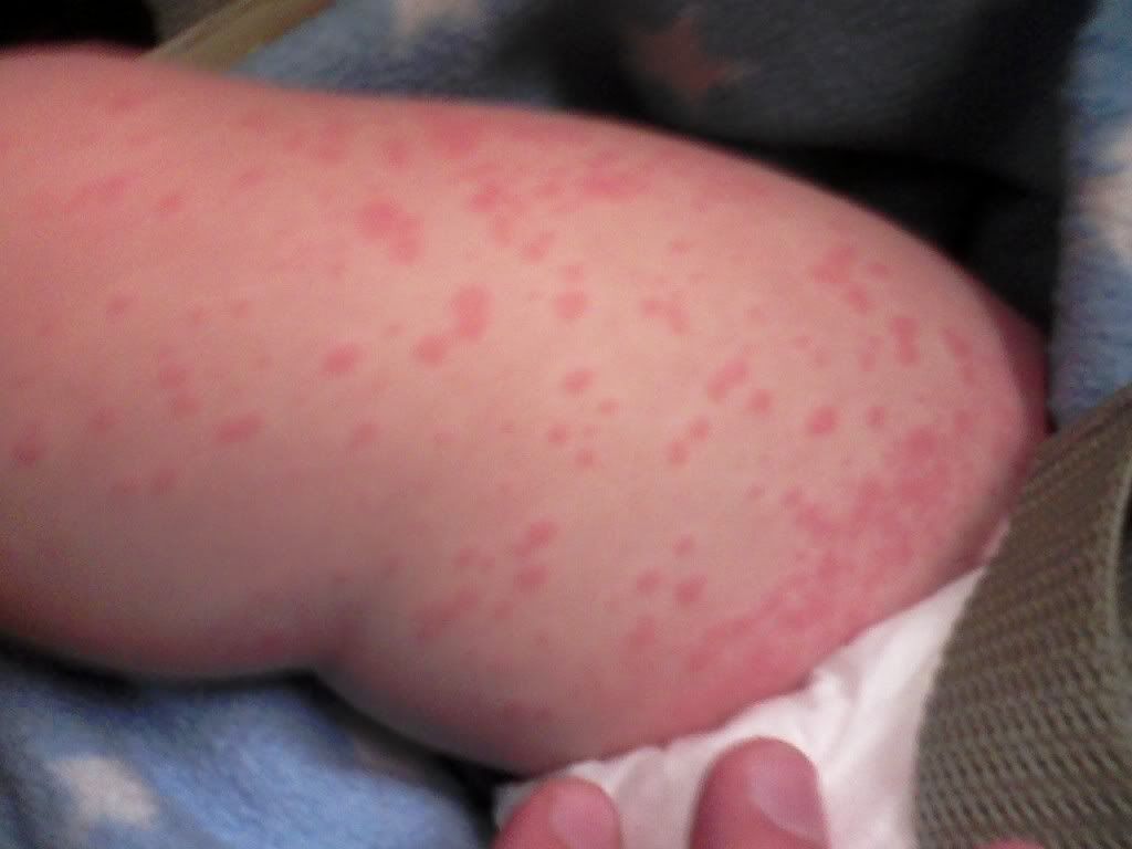 Ampicillin or Amoxicillin Rash: Caring for Your Child's ...